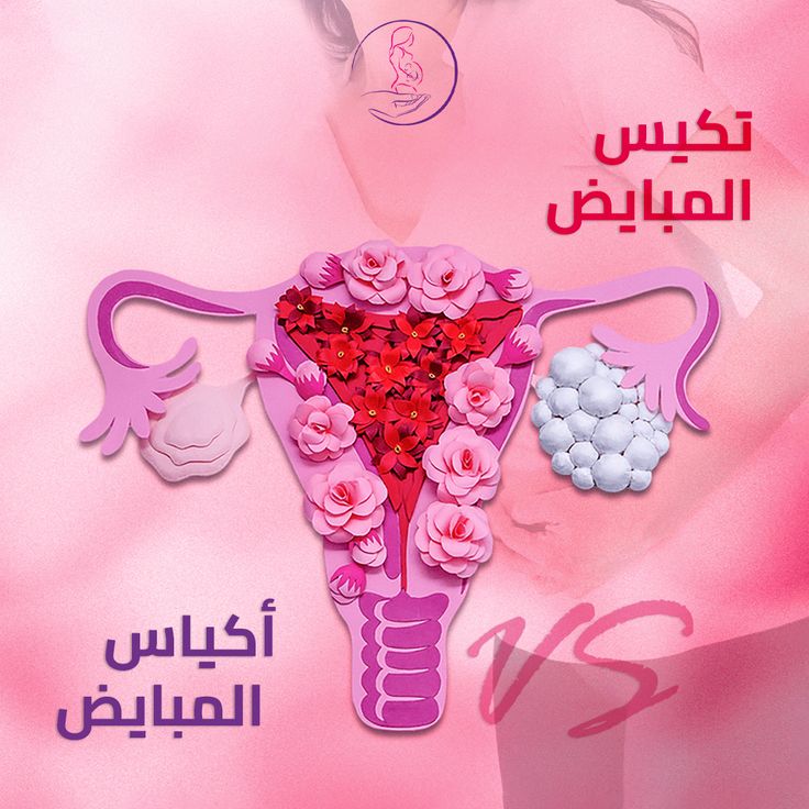PCOS